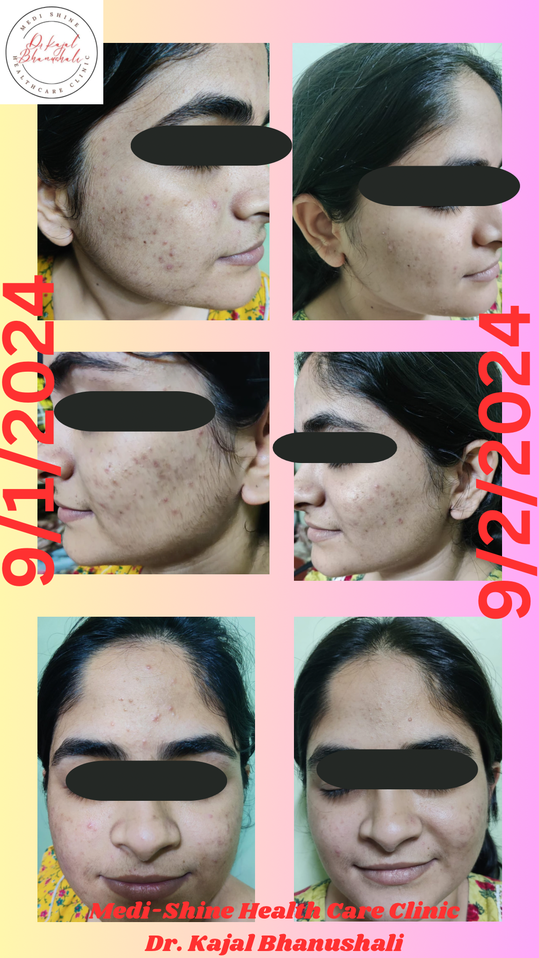 A case of PCOD induced Acne..  settling with Homoeopathy  Regularisation of Period Cycle and acne settled…  Homoeopathy Heals #trusthomoeopathy